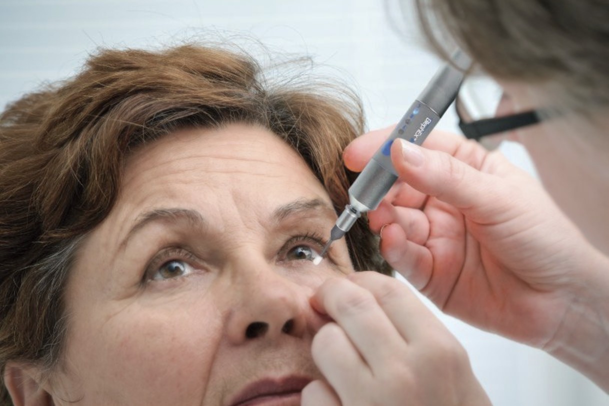 Fachkraft führt eine Blepharoexfoliation mit dem BlephEx-Handstück am Lidrand einer Patientin durch