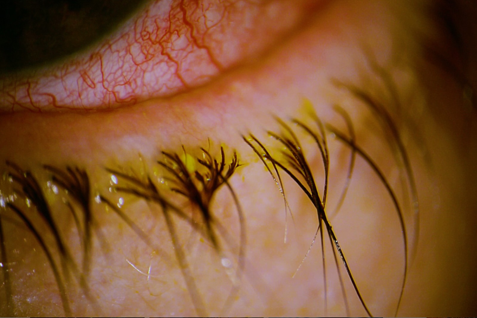 Zylindrische Manschetten am Wimpernansatz, das charakteristische Zeichen von Demodex