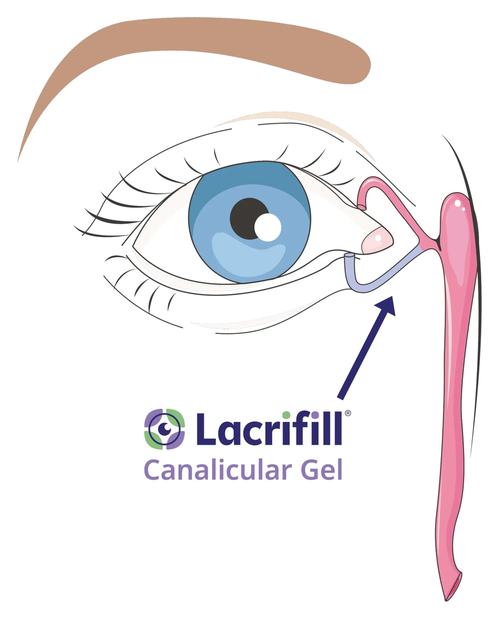 Illustration eines Auges mit den ableitenden Tränenwegen; das Lacrifill-Gel ist im unteren Tränenkanälchen dargestellt