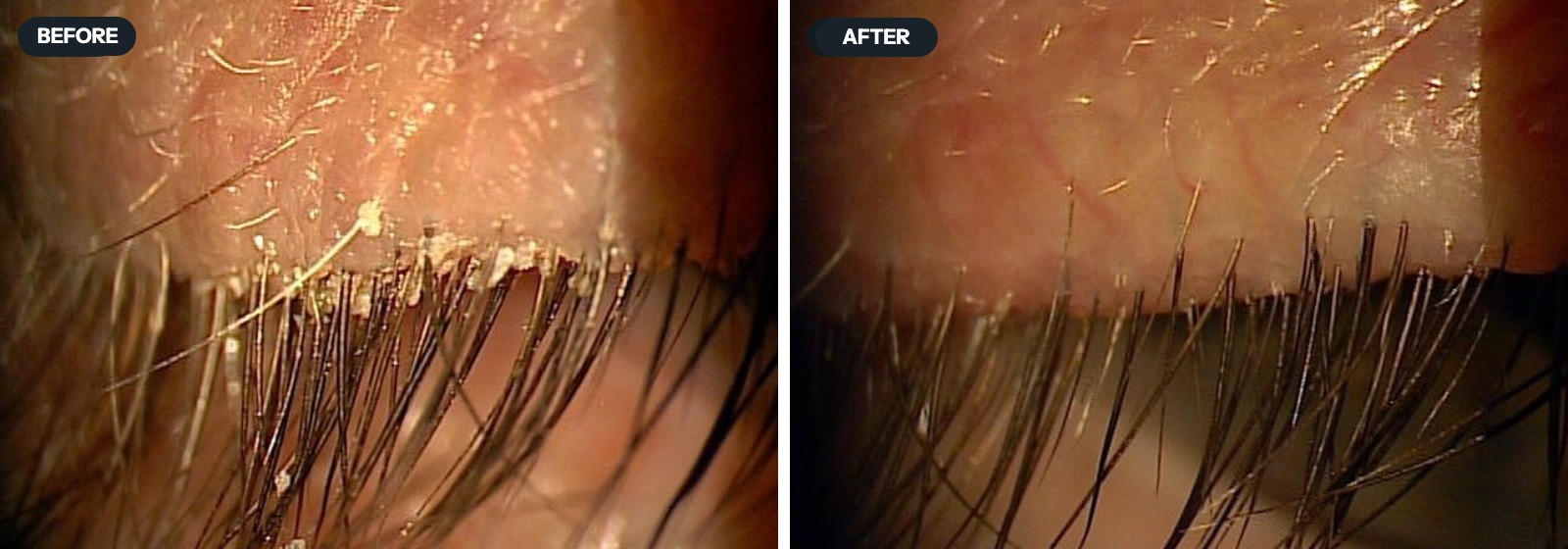 Lid margin before and after a blepharoexfoliation: crusts and collarettes on the lashes, and the same margin clean