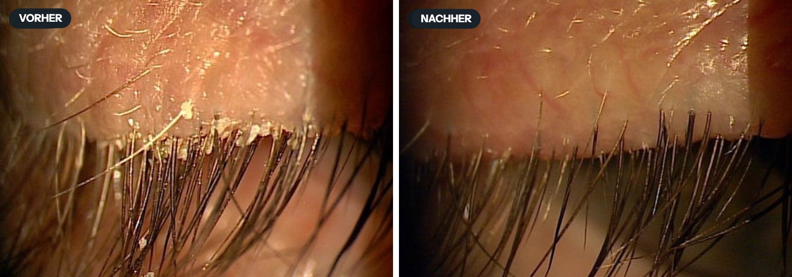 Lidrand vor und nach einer Blepharoexfoliation: Krusten und Manschetten an den Wimpern, und derselbe Lidrand sauber