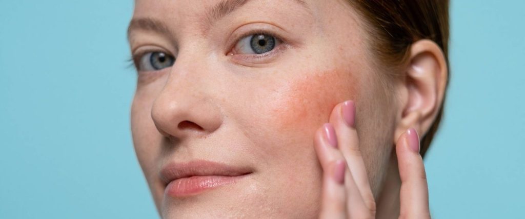 Frau mit geröteter Wange berührt ihr Gesicht, Rosacea kann auch Augen und Lider betreffen