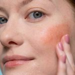 Frau mit geröteter Wange berührt ihr Gesicht, Rosacea kann auch Augen und Lider betreffen