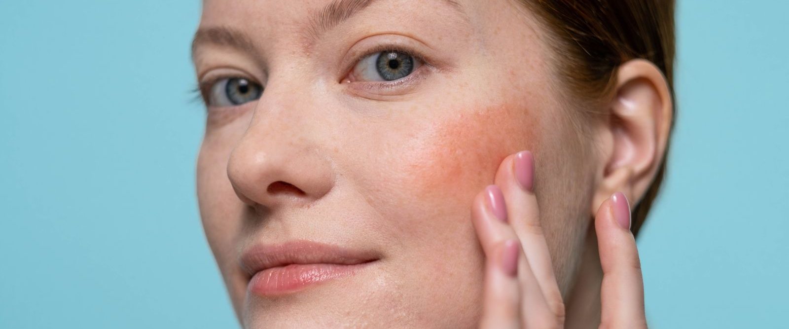 Frau mit geröteter Wange berührt ihr Gesicht, Rosacea kann auch Augen und Lider betreffen