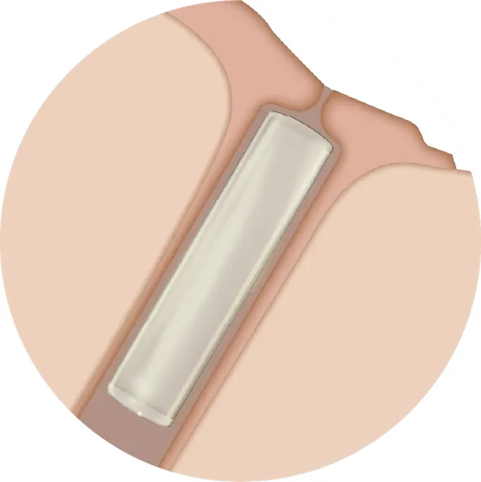 Auflösbarer Plug