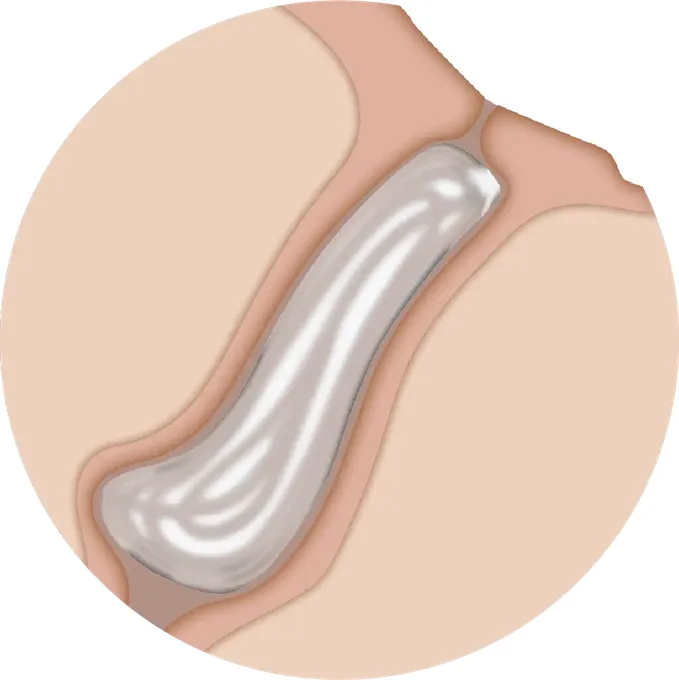 Intrakanalikulärer Plug